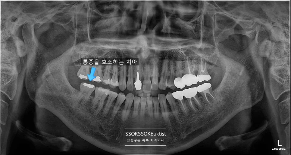 치아균열증후군 케이스1 파노라마 진단