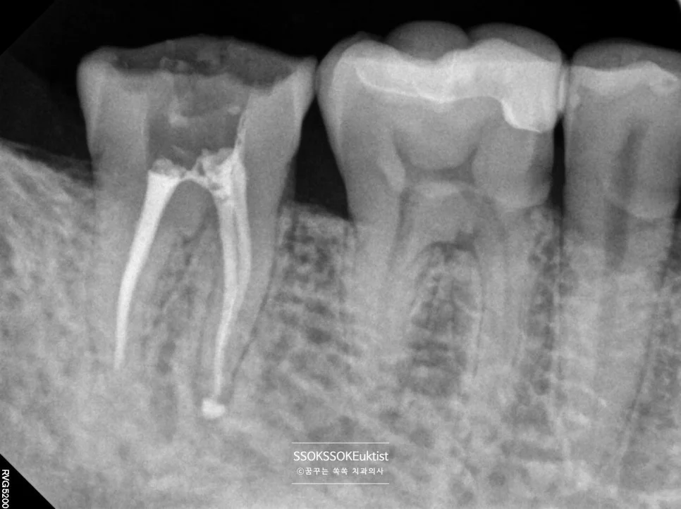 치아균열증후군 케이스1 신경치료 완료 X-ray 근관충전
