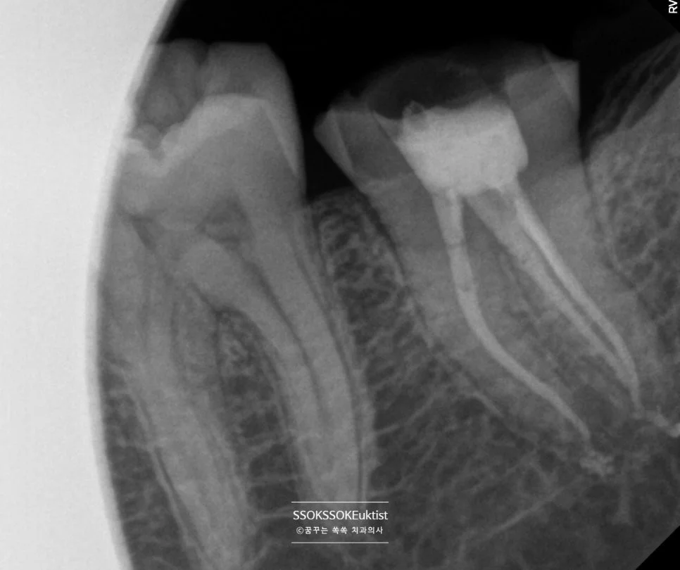 치아균열증후군 케이스2 신경치료 완료 X-ray