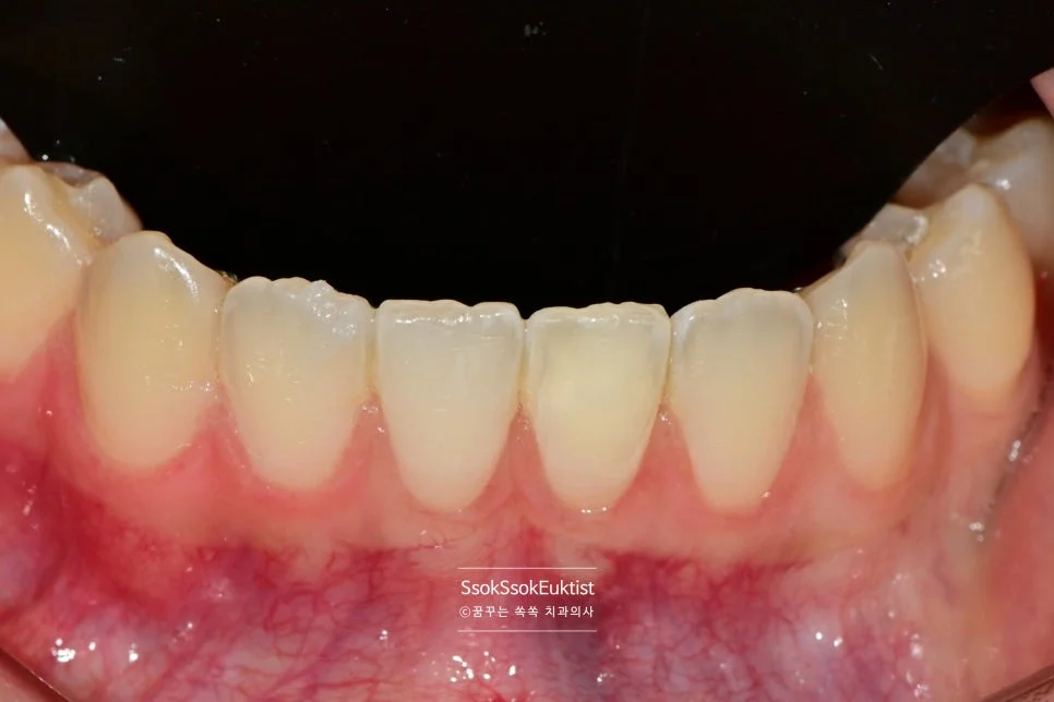 실활치 미백 후 변색 치아 색상 회복된 모습