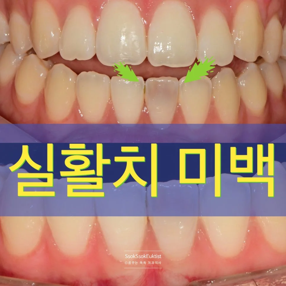 실활치 미백 전후 비교 썸네일 변색 앞니와 미백 후 모습