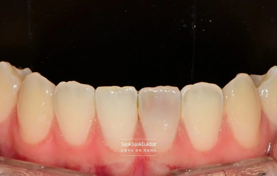 변색된 아래 앞니 클로즈업 사진 주변 치아 대비 어두운 색상