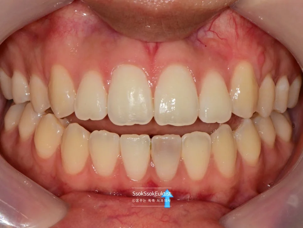실활치 미백 전 변색된 아래 앞니 구내사진 화살표 표시