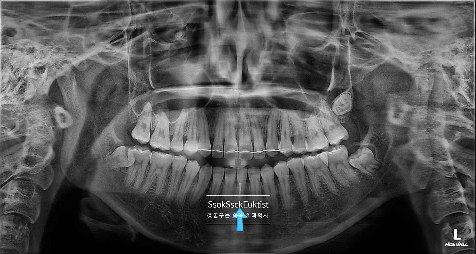 실활치 미백 치료 완료 파노라마 X-ray 최종 확인 화살표