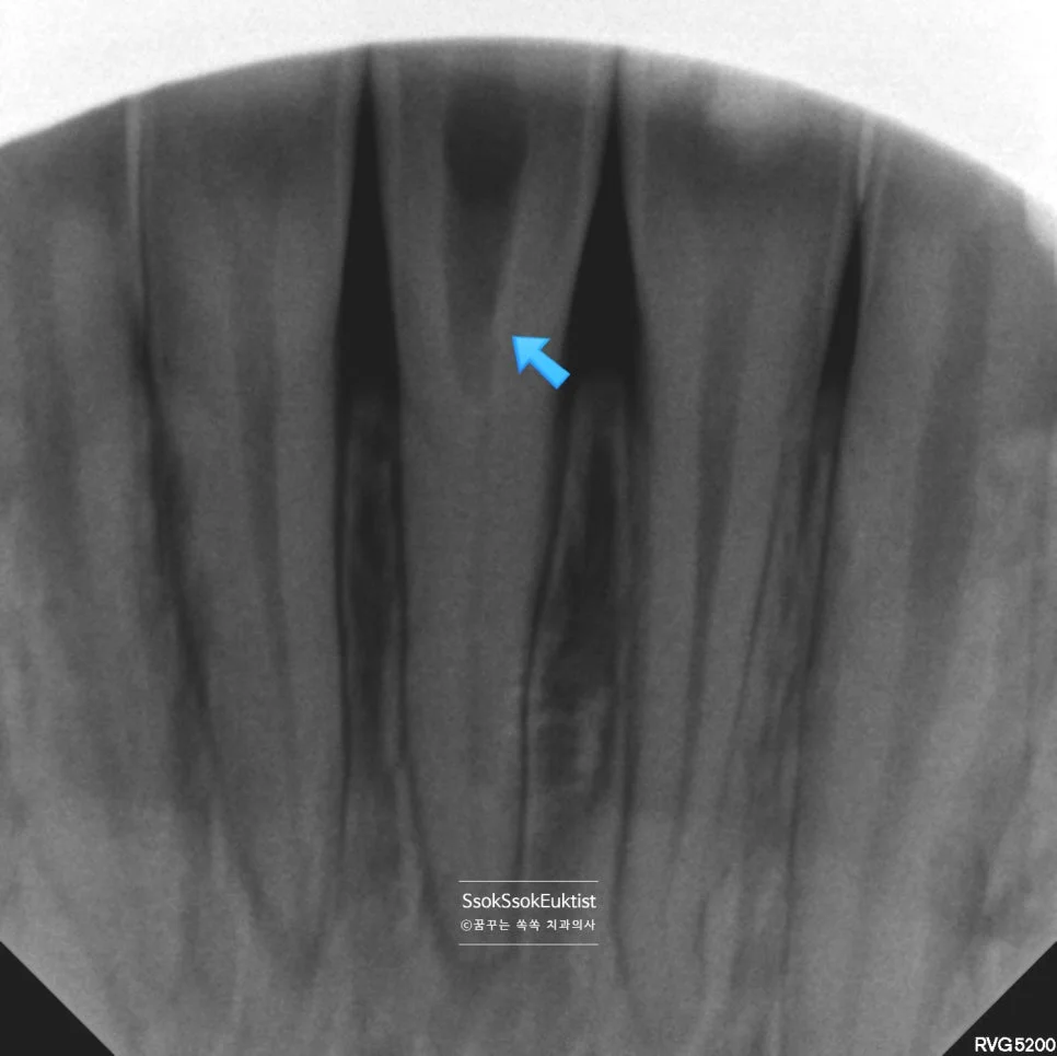 신경치료 중 X-ray 신경관 접근 방향 확인 화살표