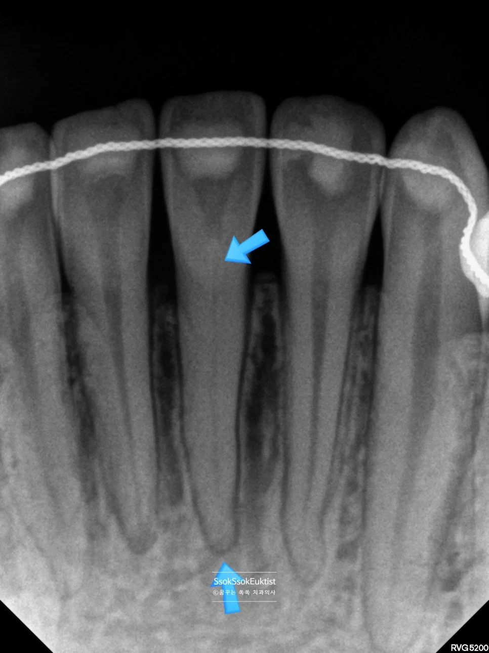 실활치 X-ray 좁아진 신경관 화살표 표시 진단