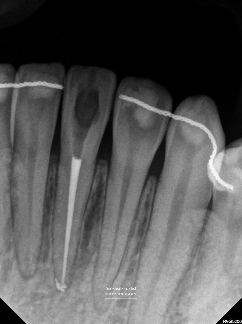 신경치료 완료 X-ray 근관충전 뿌리 끝까지 충전