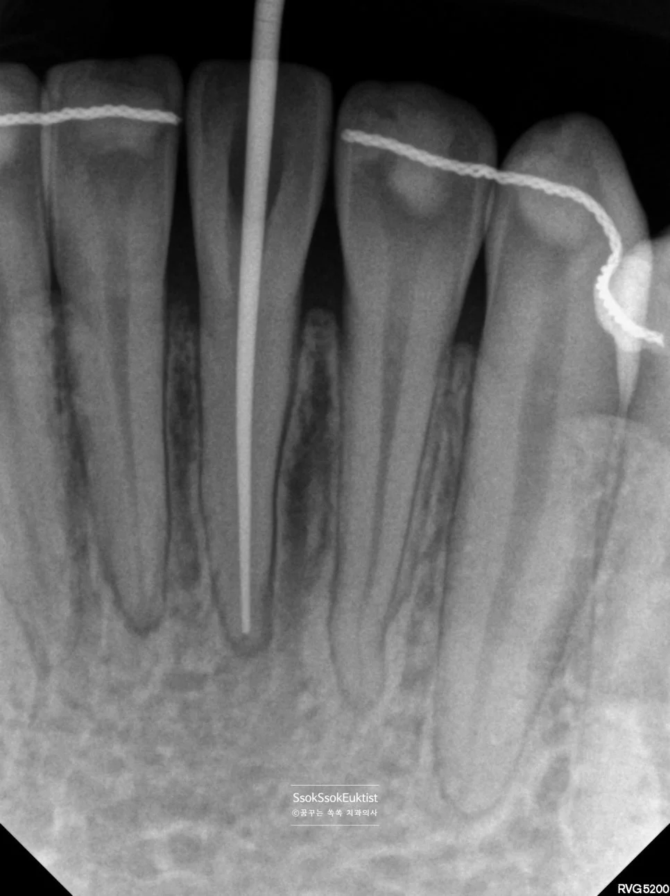신경치료 근관장 측정 X-ray 파일 삽입 확인