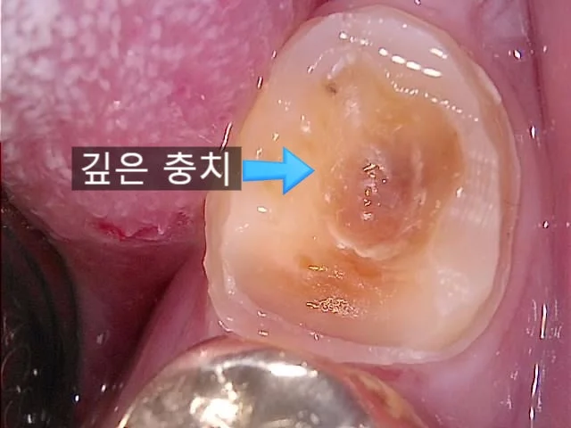 수복물 하방 깊은 충치 발견 임상 사진