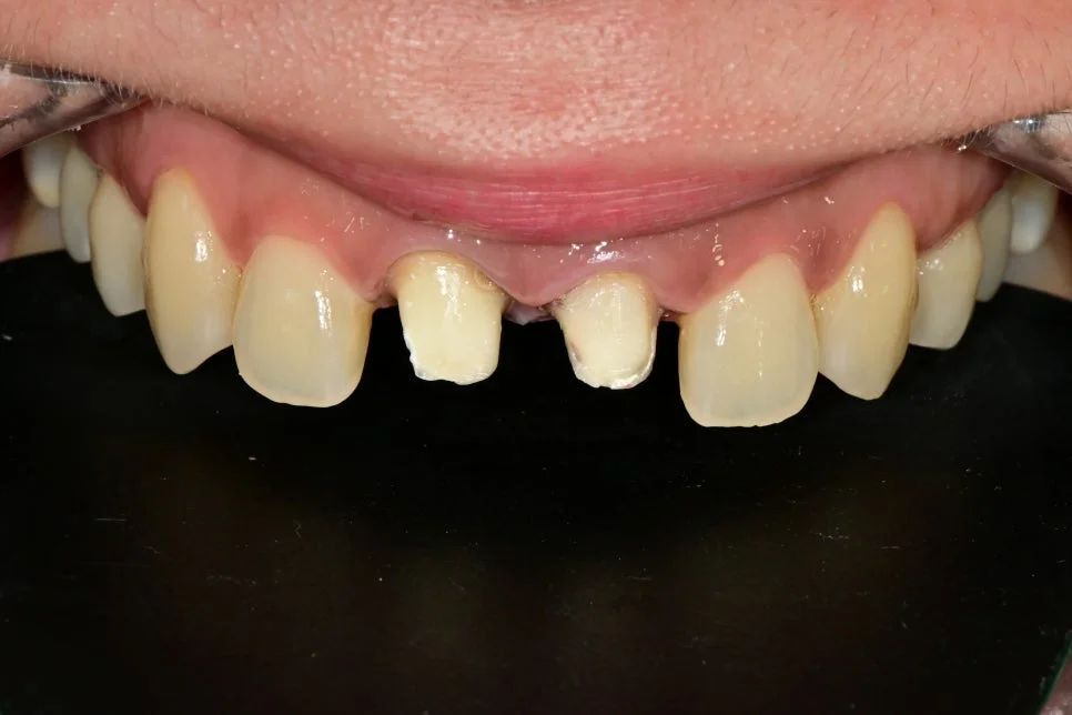 실활치 미백 2회 후 밝아진 앞니 결과