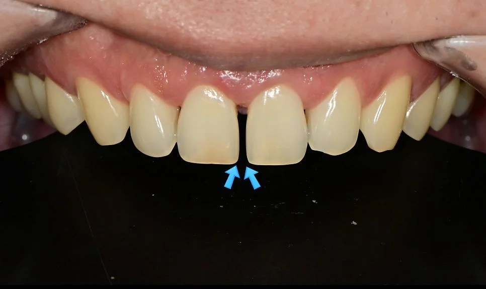 정중이개 화살표 표시 치료 전