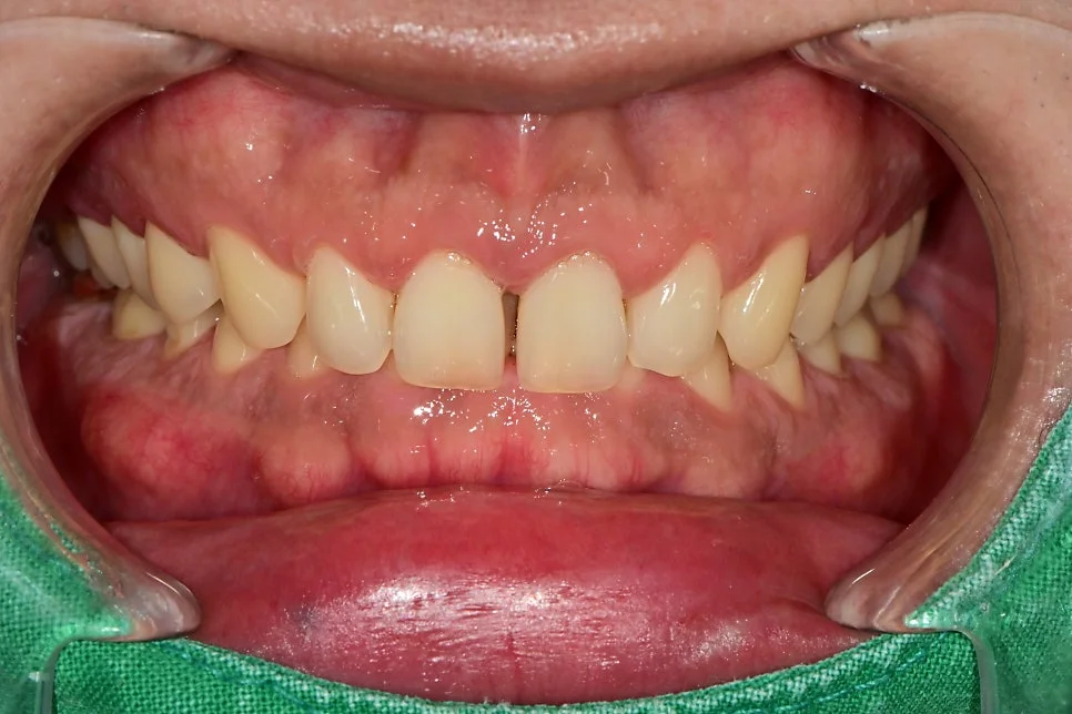 정중이개 치료 전 정면 사진