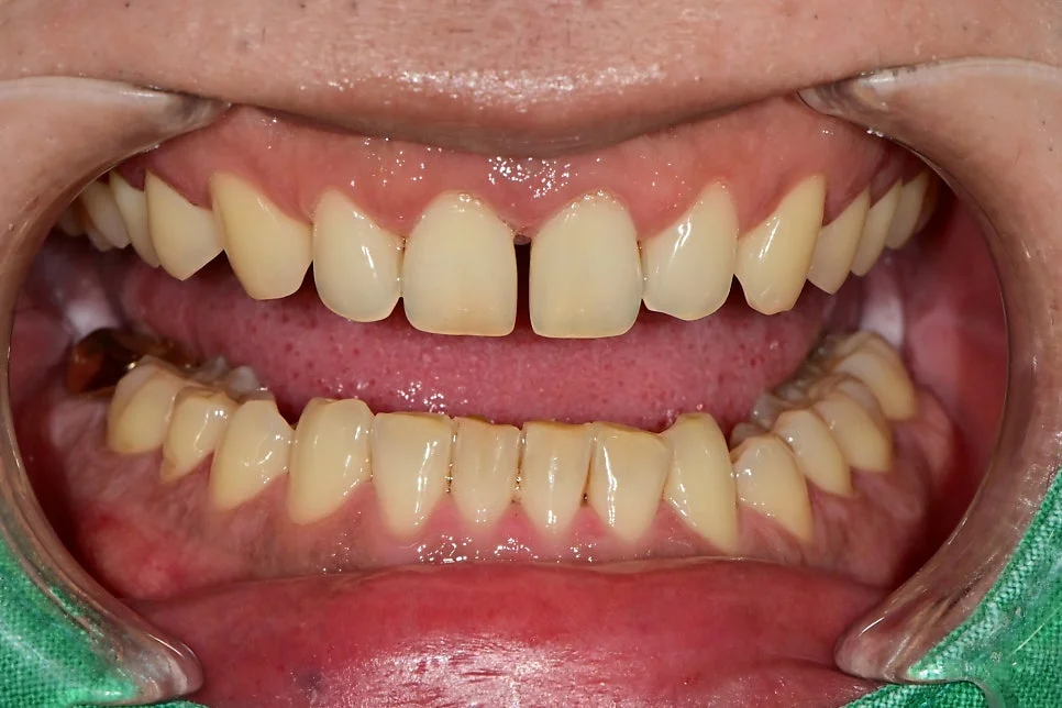 정중이개 상하 치아 관계 사진