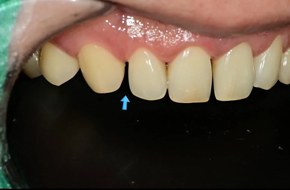 정중이개 확대 치료 전