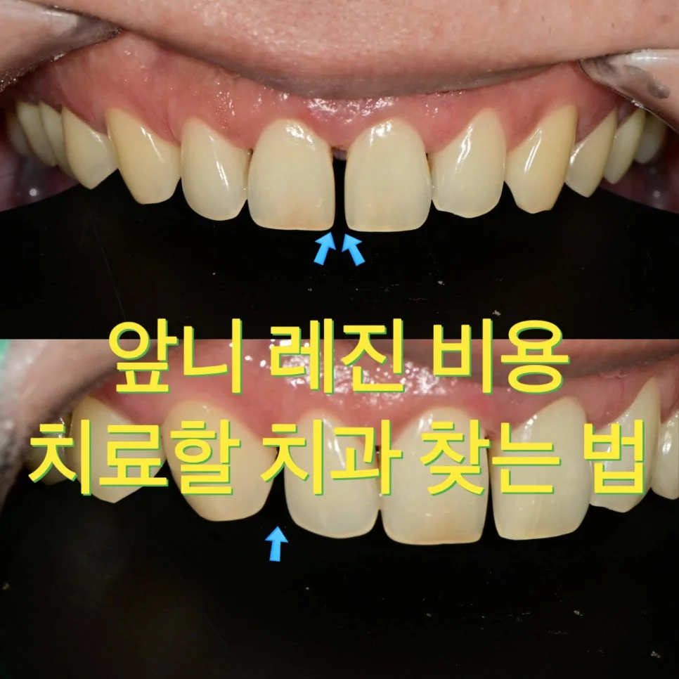 정중이개 앞니 벌어짐 타이틀 사진