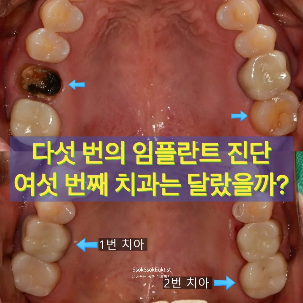 탈락 크라운 충치 치료 전 사진