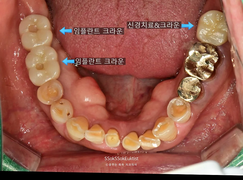 전체 치료 완료 라벨 표시 결과