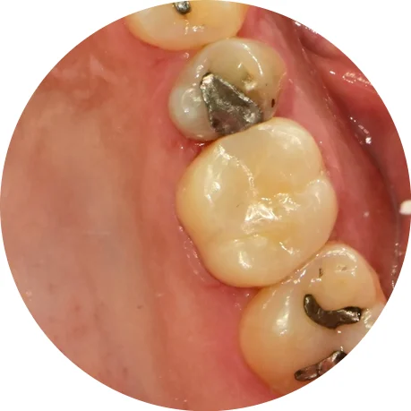 신경치료 후 최종 크라운 완성 교합면