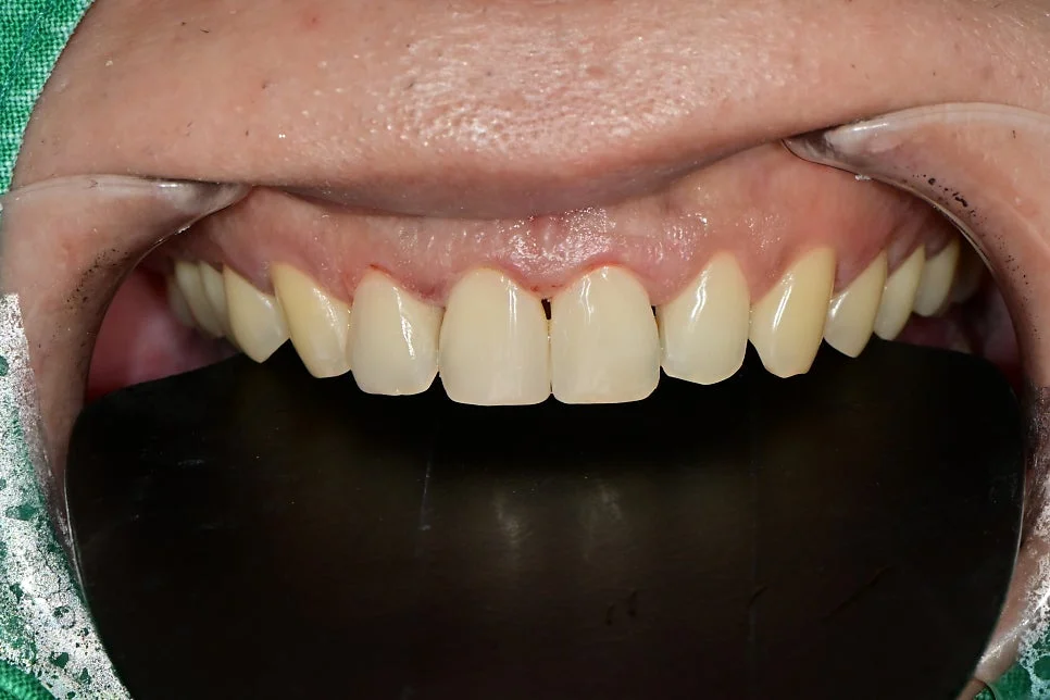 최종 정중이개 레진 결과