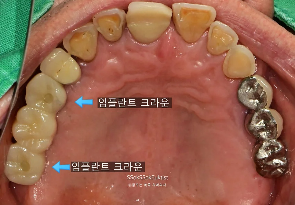 하악 임플란트 크라운 최종 결과
