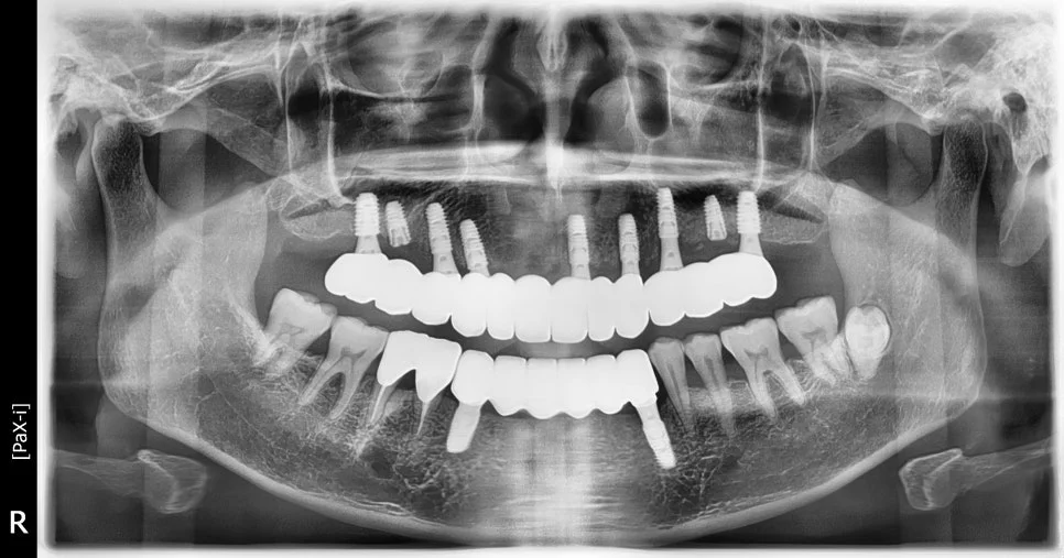 전악 임플란트 최종 완료 파노라마 X-ray - 서울쏙쏙치과