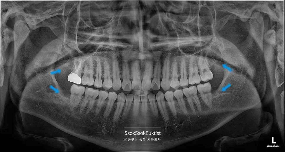 사랑니 4개 발치 완료 최종 파노라마