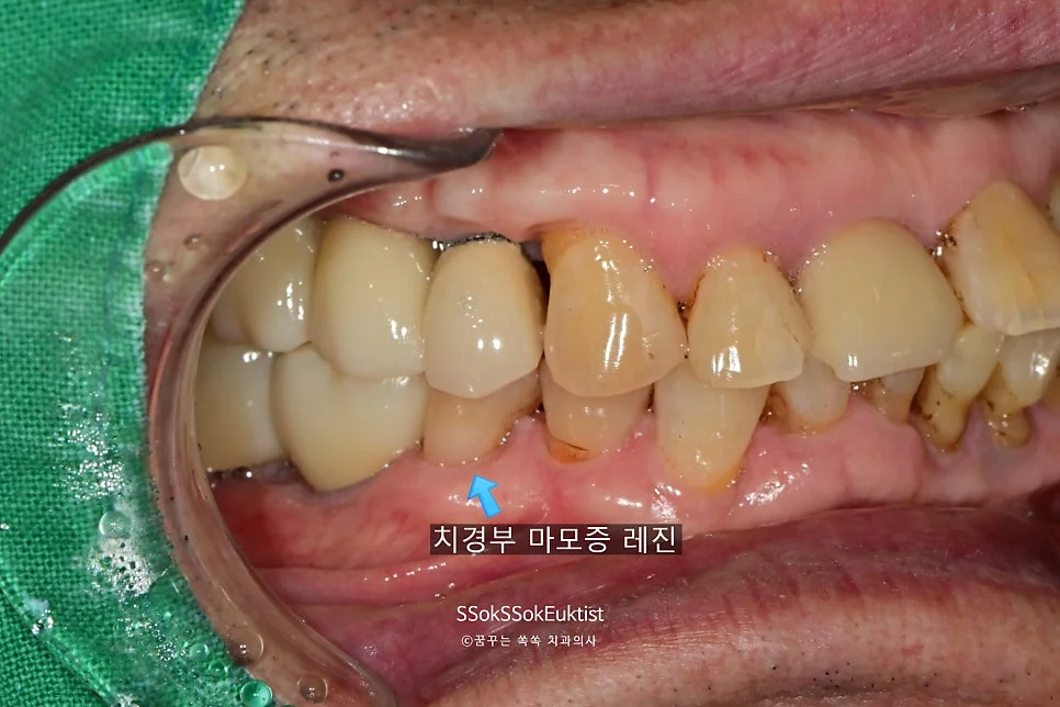 치경부 마모증 레진 최종 결과