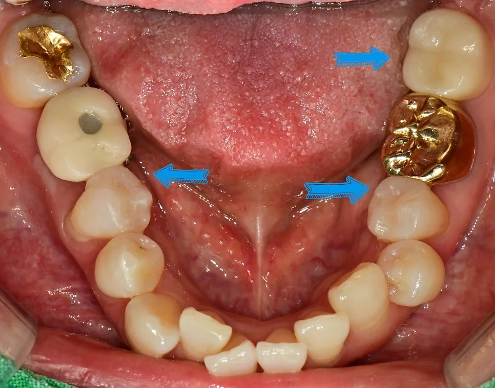최종 치료 완료 보철물 접착 결과 사진
