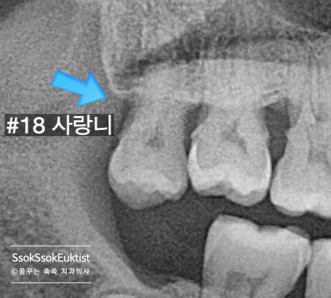 최종 지르코니아 크라운 장착 완료 결과 사진