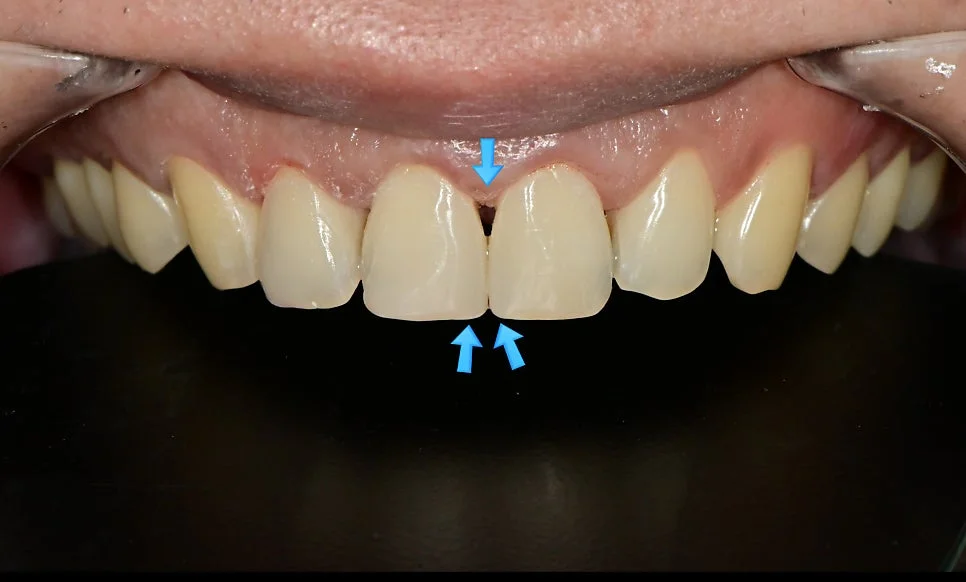 1차 레진 결과 검은 영역 표시