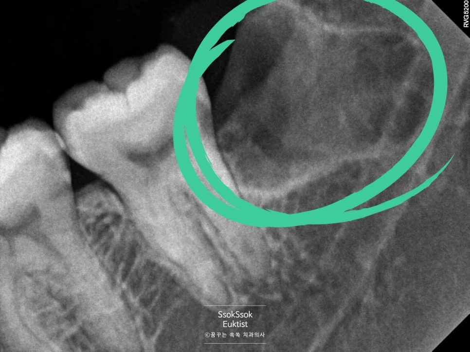 첫 번째 수면마취 왼쪽 사랑니 발치 진행