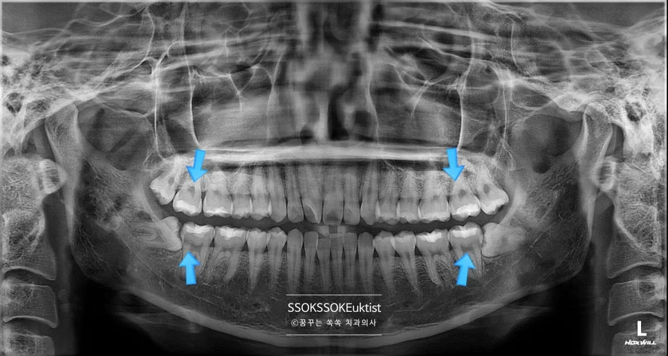 사랑니 4개 위치 파노라마 엑스레이 진단
