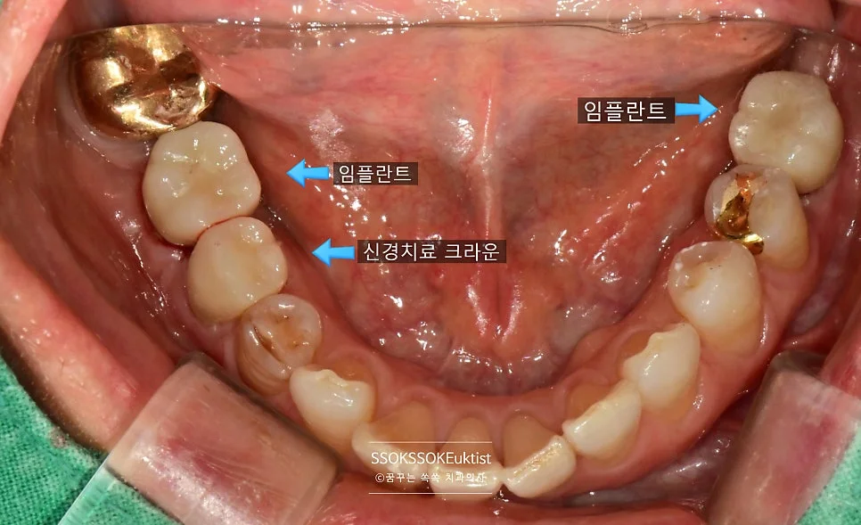 앞니 임플란트 시술 후 하악 교합면 크라운 완료