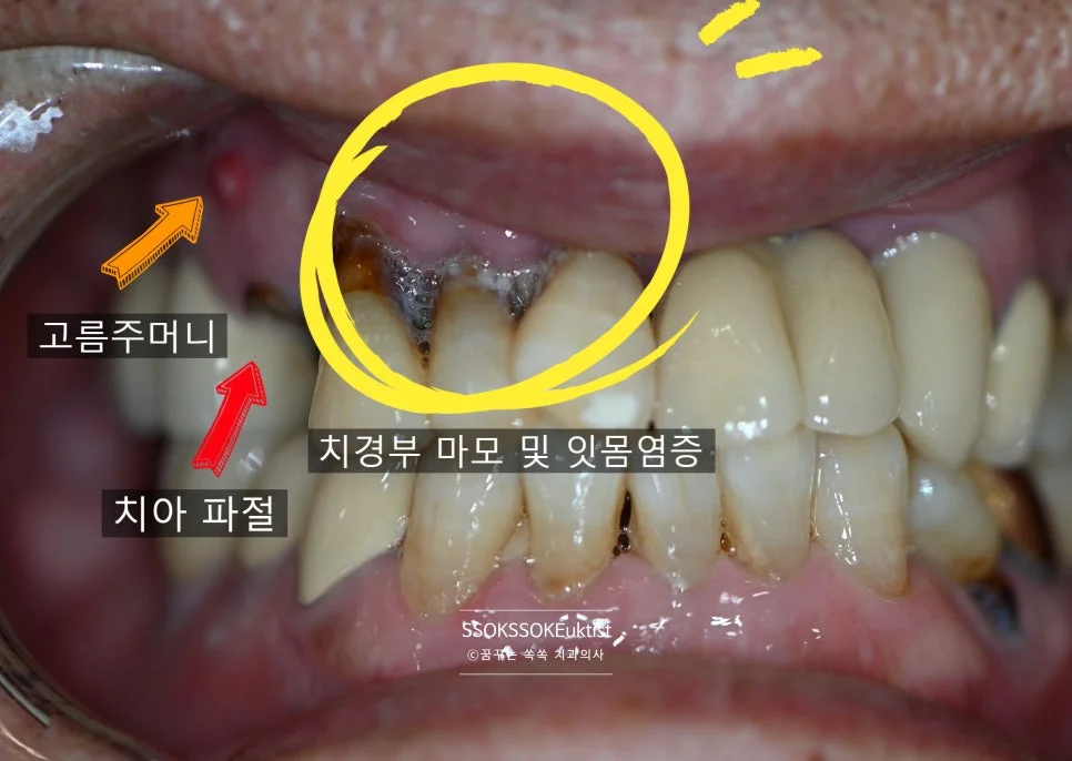 앞니 임플란트 시술 전 정면 잇몸 염증 파절 상태