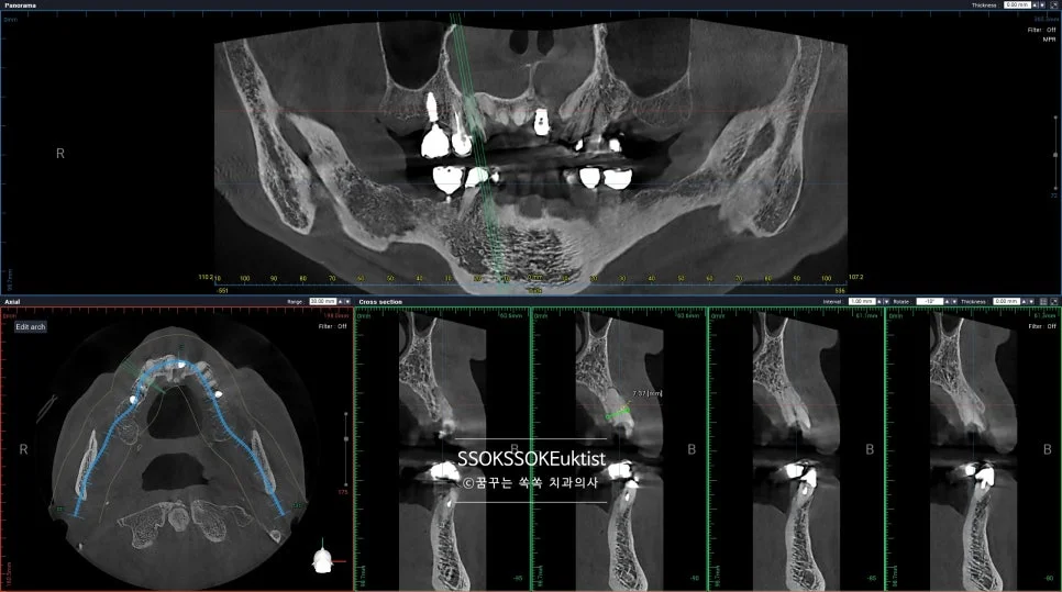 앞니 임플란트 CBCT 3차원 식립 계획