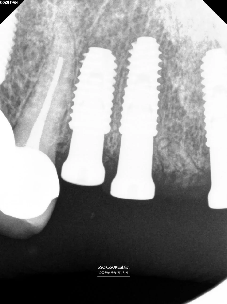 앞니 임플란트 치근단 X-ray 2-3mm 깊이 식립 확인