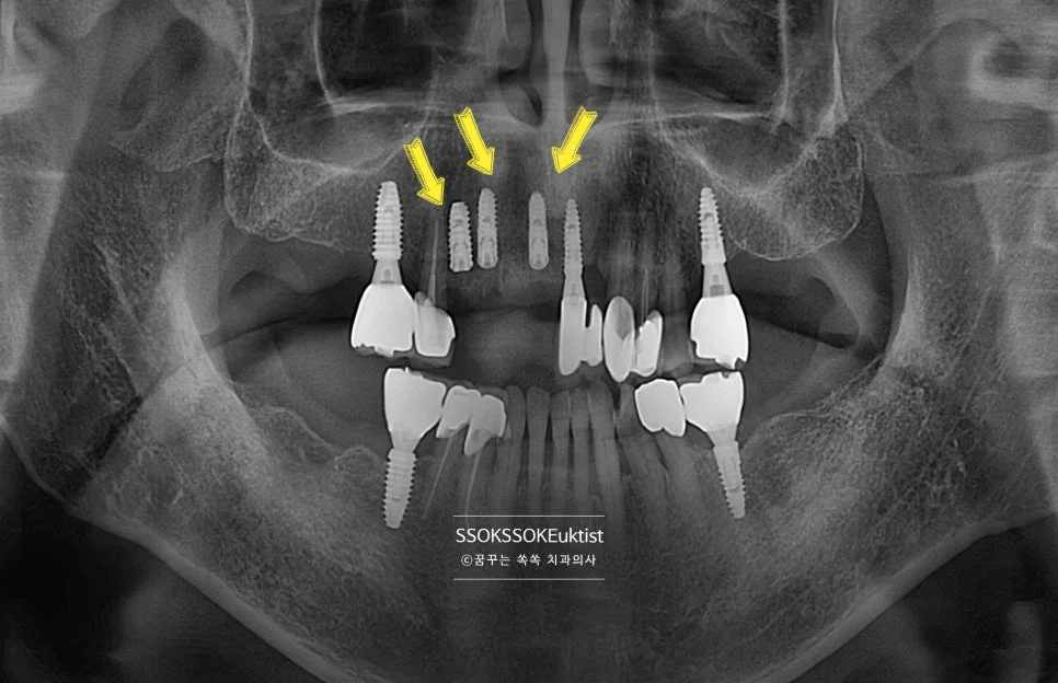 앞니 임플란트 식립 후 파노라마 3개 식립 확인