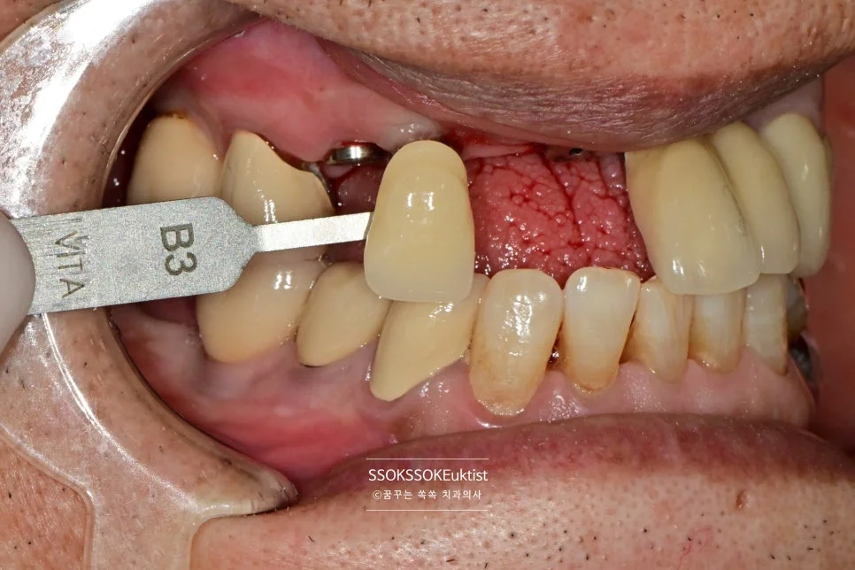 앞니 임플란트 쉐이드 가이드 색상 매칭