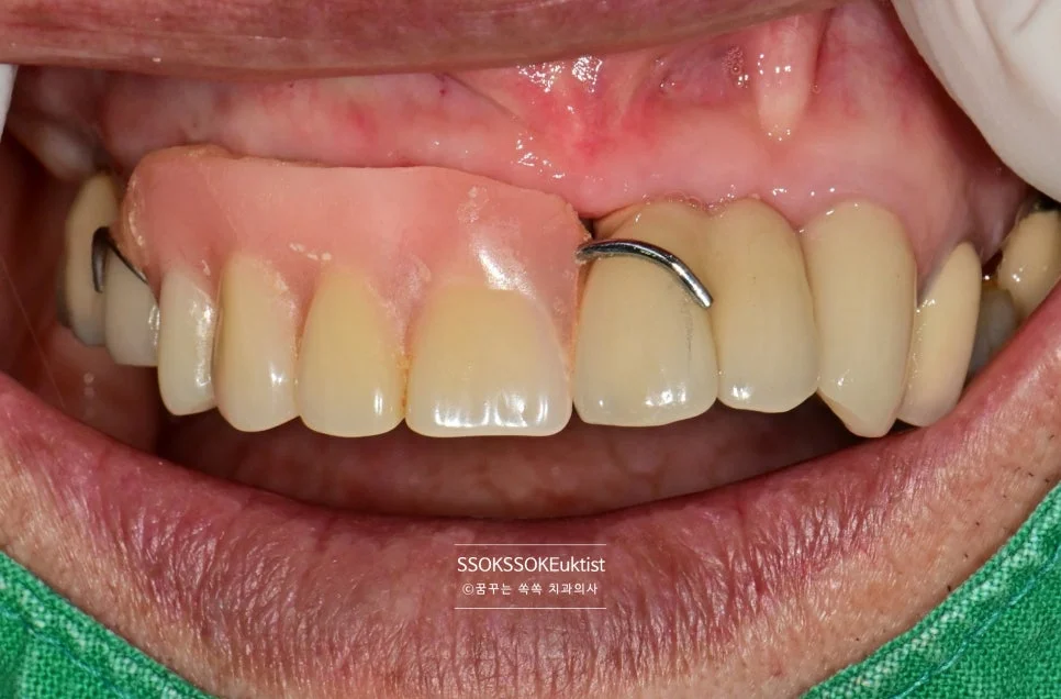 앞니 임플란트 임시 틀니 플리퍼 장착