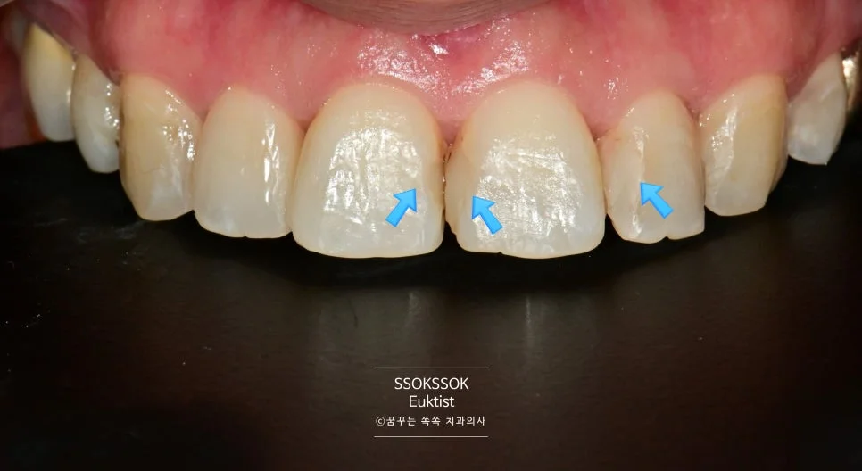 앞니 레진 2차 내원 재치료 전 상태