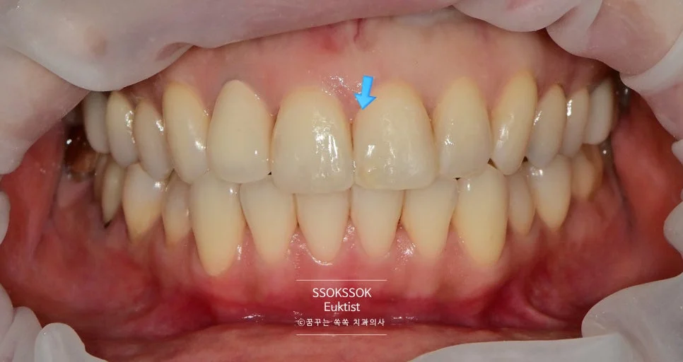 앞니 레진 변색 케이스2 재치료 후 자연스러운 결과