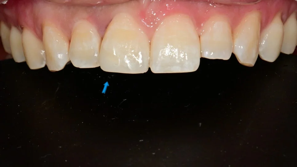 앞니 깨짐 레진 복원 치료 후 Case2