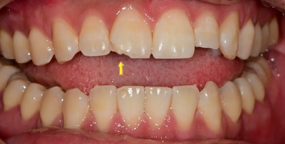 앞니 깨짐 치료 전 구내사진 화살표 표시 Case2