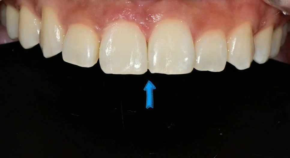 앞니 벌어짐 한쪽만 레진 치료 후 Case3