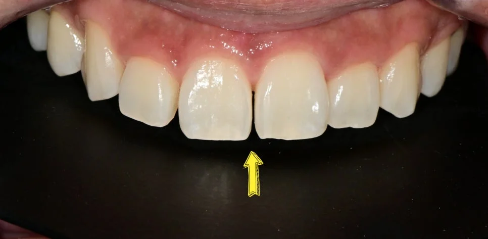 앞니 벌어짐 다이아스테마 치료 전 화살표 표시 Case3