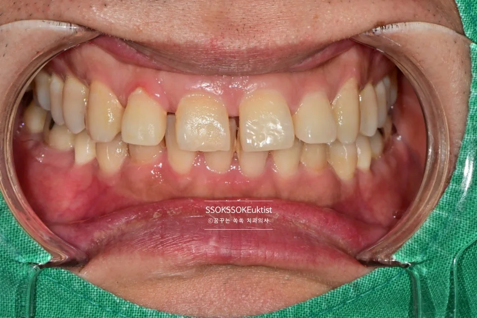 앞니 사이 벌어짐 치료 전 정면 구내 사진