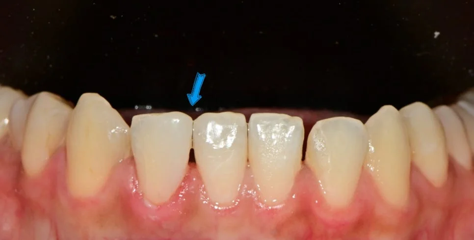 앞니 레진 재치료 최종 결과 다각도 Case4