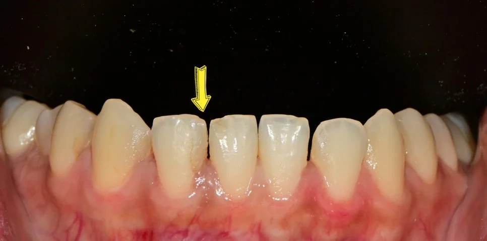 아래 앞니 기존 변색 레진 제거 후 재치료 Case4