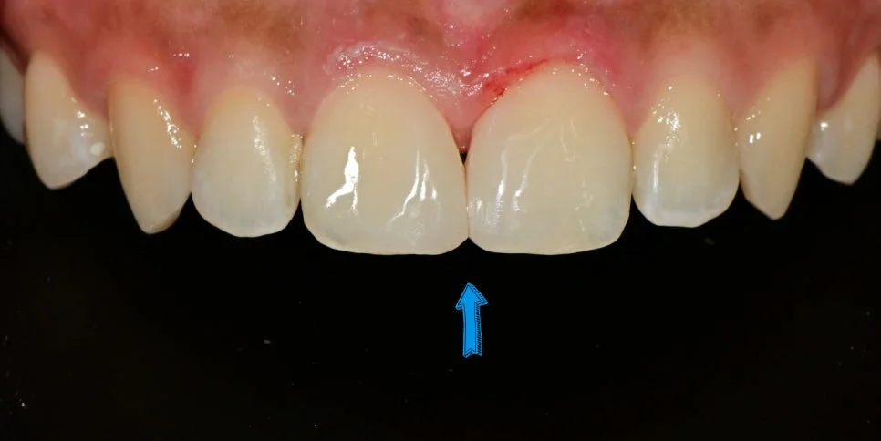 심한 다이아스테마 위 앞니 레진 재치료 후 Case4