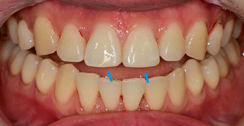 앞니 파절 레진 복원 치료 후 Case1